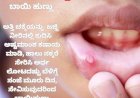 ಬಾಯಿ ಹುಣ್ಣಿಗೆ ಸುಲಭದ ಮದ್ದು